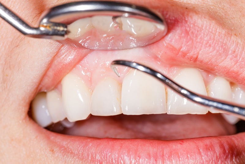 An image of a dental patient with gum disease.