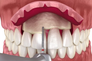 An image of crown lengthening.