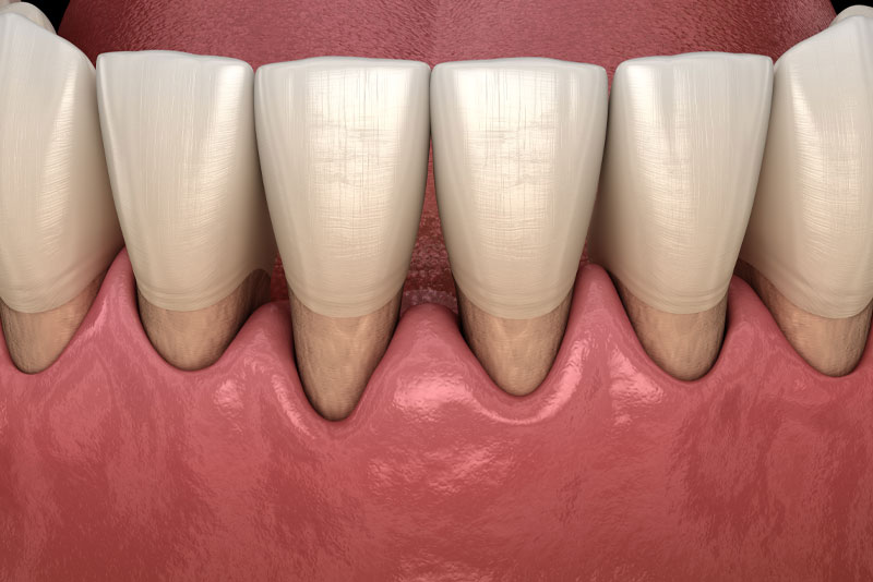 An image of gum recession.