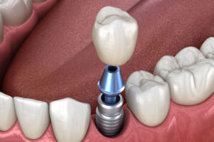 An image of a dental implant model.