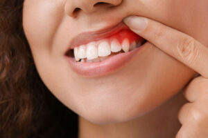 An image of a woman with periodontal disease.