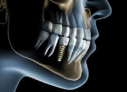 An image of a dental implant.