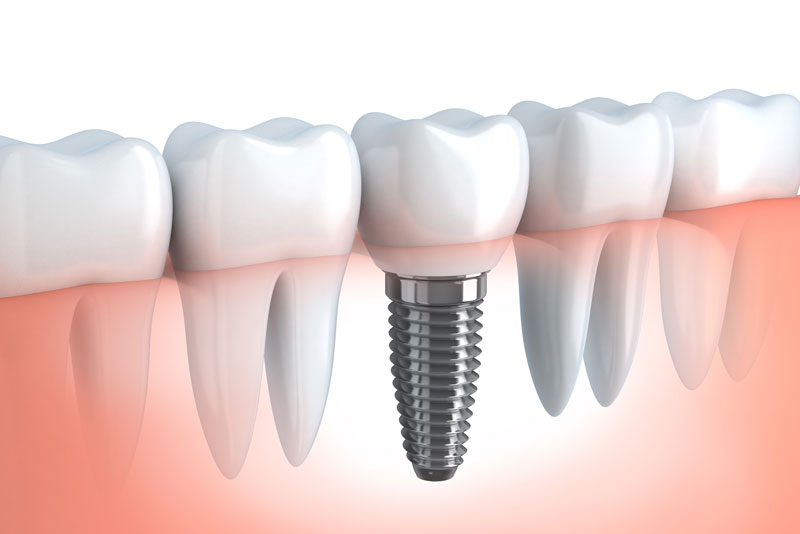 An image of a dental implant.