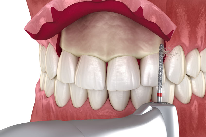 An image of a crown lengthening procedure.