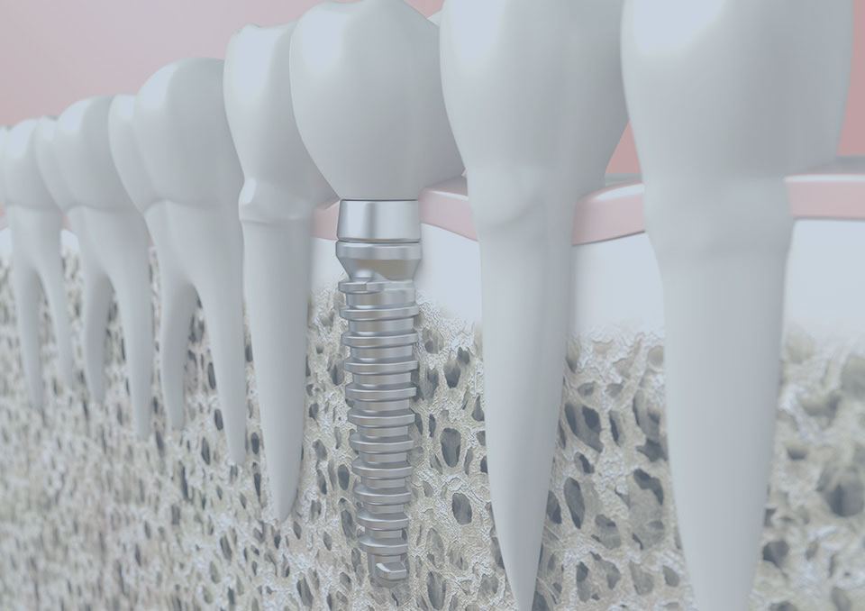 Tooth Extractions Bloomfield Hills, MI