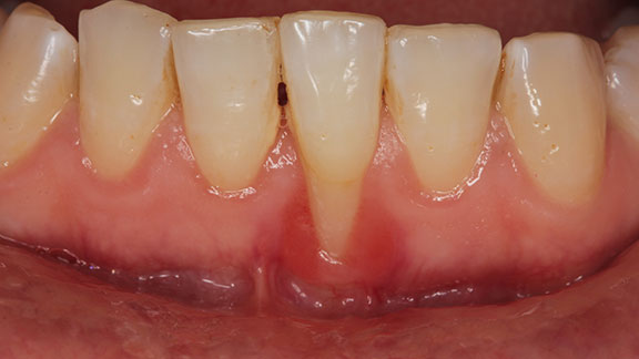 Minimally Invasive Dental Treatments Bloomfield Hills, MI