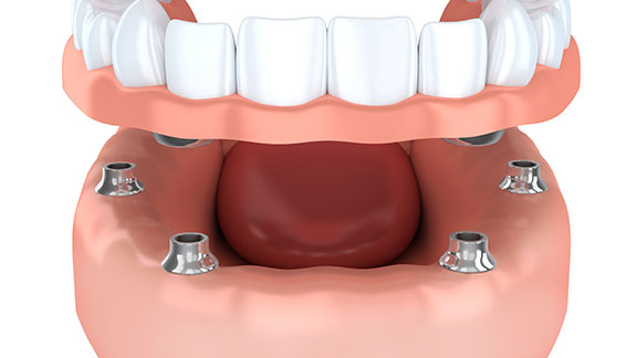 Implants vs. Dentures Bloomfield Hills, MI