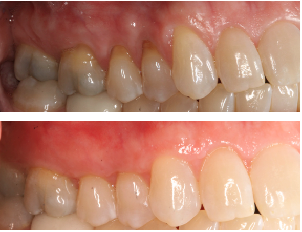 Connective Tissue Graft Before and After