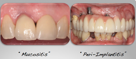 Implant Disease Treatment Before and After