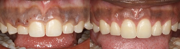 fix gummy smile before and after
