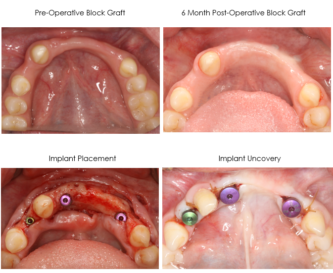 Dental Implant Placement 