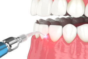 An image of laser surgery gum disease treatment.