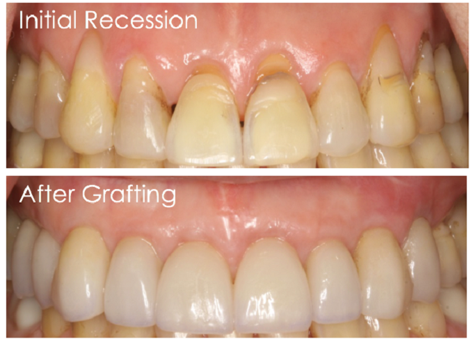 Before and after gum recession comparison with gum grafting treatment in Bloomfield Hills, MI