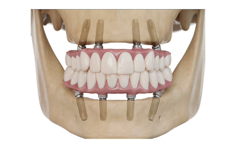 How Full Arch Dental Implants Compare to Traditional Dentures