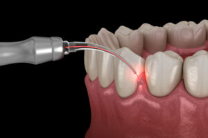 An image of a laser used on gums to treat gum disease.