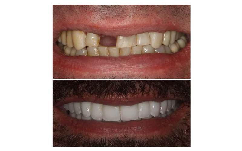 full mouth rehabilitation implant