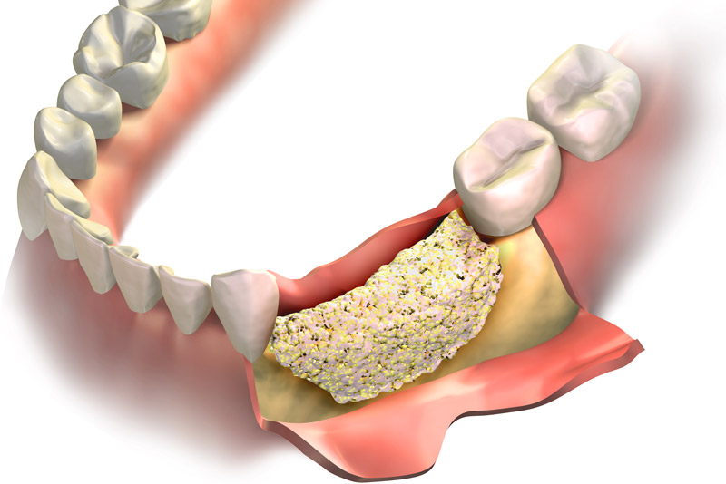 An image of a bone graft model.