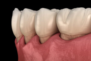 An image of a model with gum recession.