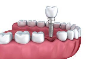 An image of a. dental implant model.