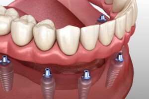 An image of an implant supported denture model.