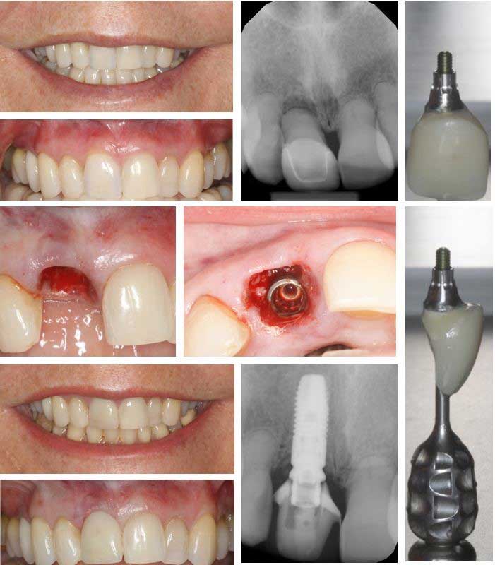 the implant placement procedure