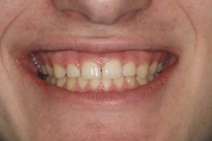 dental patient before a crown lengthening procedure