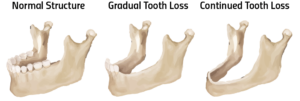 diagram of jaw bone degradation when missing teeth