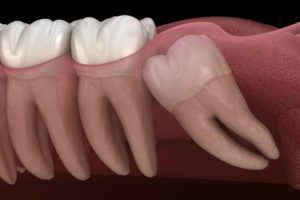 Impacted Wisdom Tooth Graphic