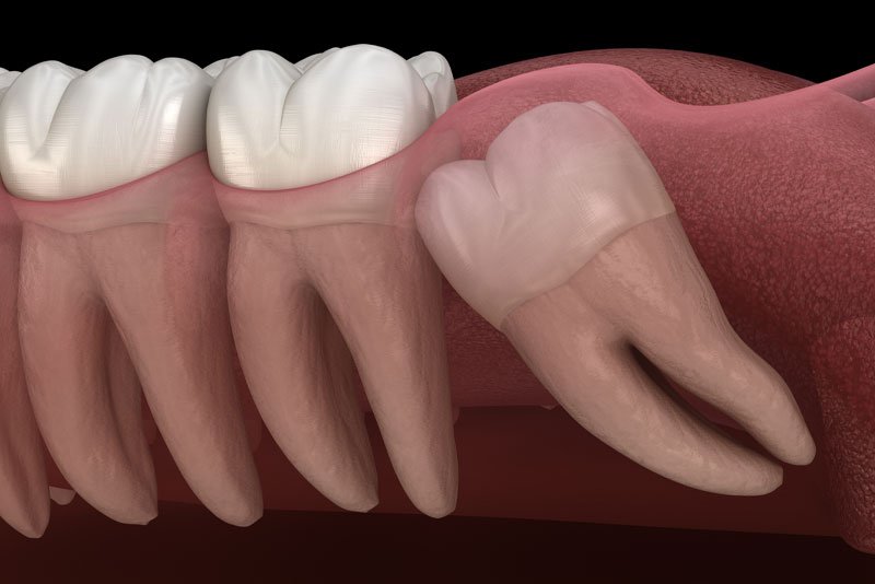 Impacted Wisdom Tooth Graphic