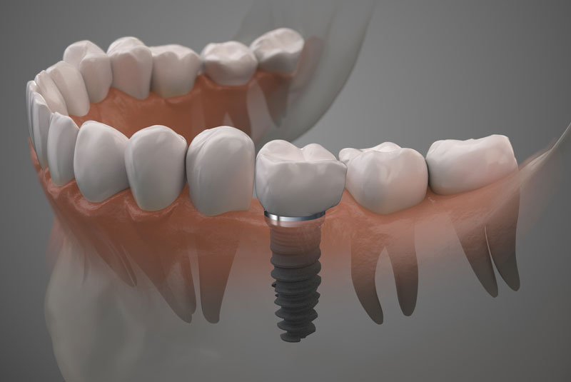 How A Dental Implant Looks In Your Mouth