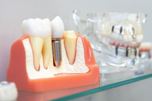 Dental Implants In Your Bone, Model