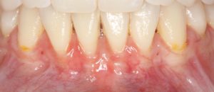 Gumline with Mucogingival Defects