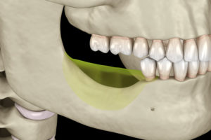 Jaw Bone Loss Graphic