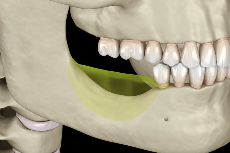 The Importance of Bone Grafting in Dental Implant Treatment Anderson