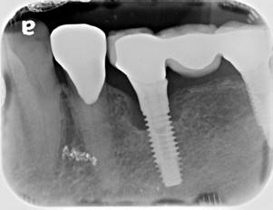 Dental Implant With Gum Disease Before