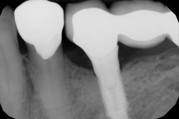 Dental Implant With Gum Disease After