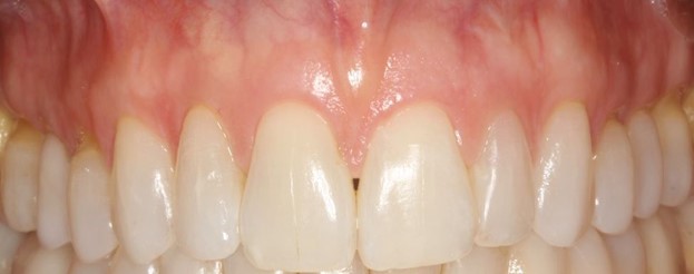 Dental Patient's Sensitive Teeth After Their Soft Tissue Graft