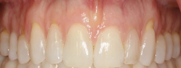 Dental Patient's Sensitive Teeth Before Their Soft Tissue Graft