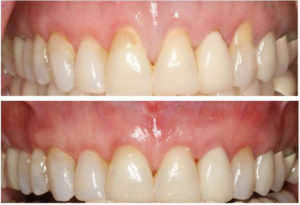 images of two upper arch teeth in need of a tunneling allograph soft tissue procedure