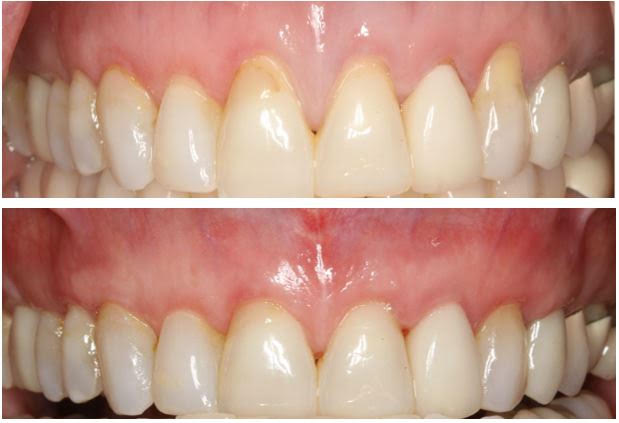 images of two upper arch teeth in need of a tunneling allograph soft tissue procedure