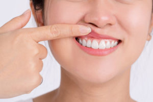 a dental patient showing off the results of gum recession.