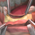 a dental one graft on a bottom jaw.