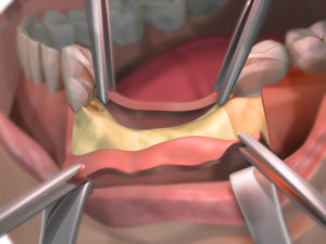a dental one graft on a bottom jaw.