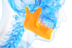 a dental patient xray showing a bone graft.