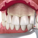 a crown lenthening procedure with a skin flap lifted model.