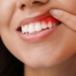 a close up picture of a patient lifting up her upper lip to show the periodontist where her gum disease is so it can be treated with ozone therapy