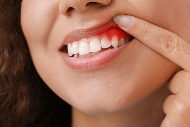 a close up picture of a patient lifting up her upper lip to show the periodontist where her gum disease is so it can be treated with ozone therapy