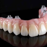 a full arch zirconia prosthesis against a black background. the zirconia full arch prosthesis has four zirconia dental implants in them.