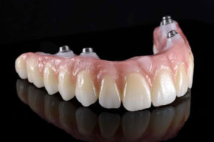 a full arch zirconia prosthesis against a black background. the zirconia full arch prosthesis has four zirconia dental implants in them.
