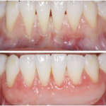 an image of a before and after photo of a gum grafting procedure